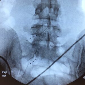 Dorsal Root Ganglion Stimulators | Advanced Pain Management & Spine ...